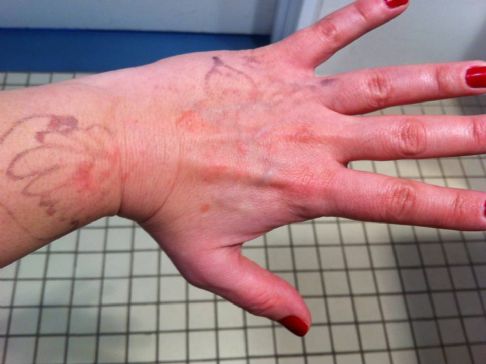 Henna tatovering allergi behandling