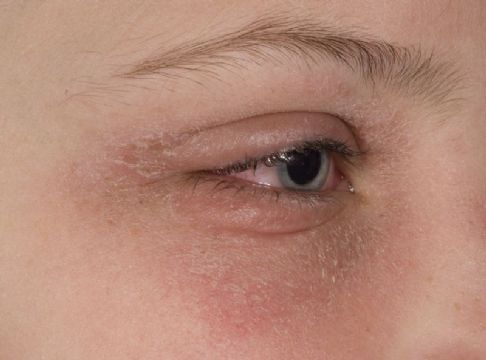 Symptomer – For Allergi
